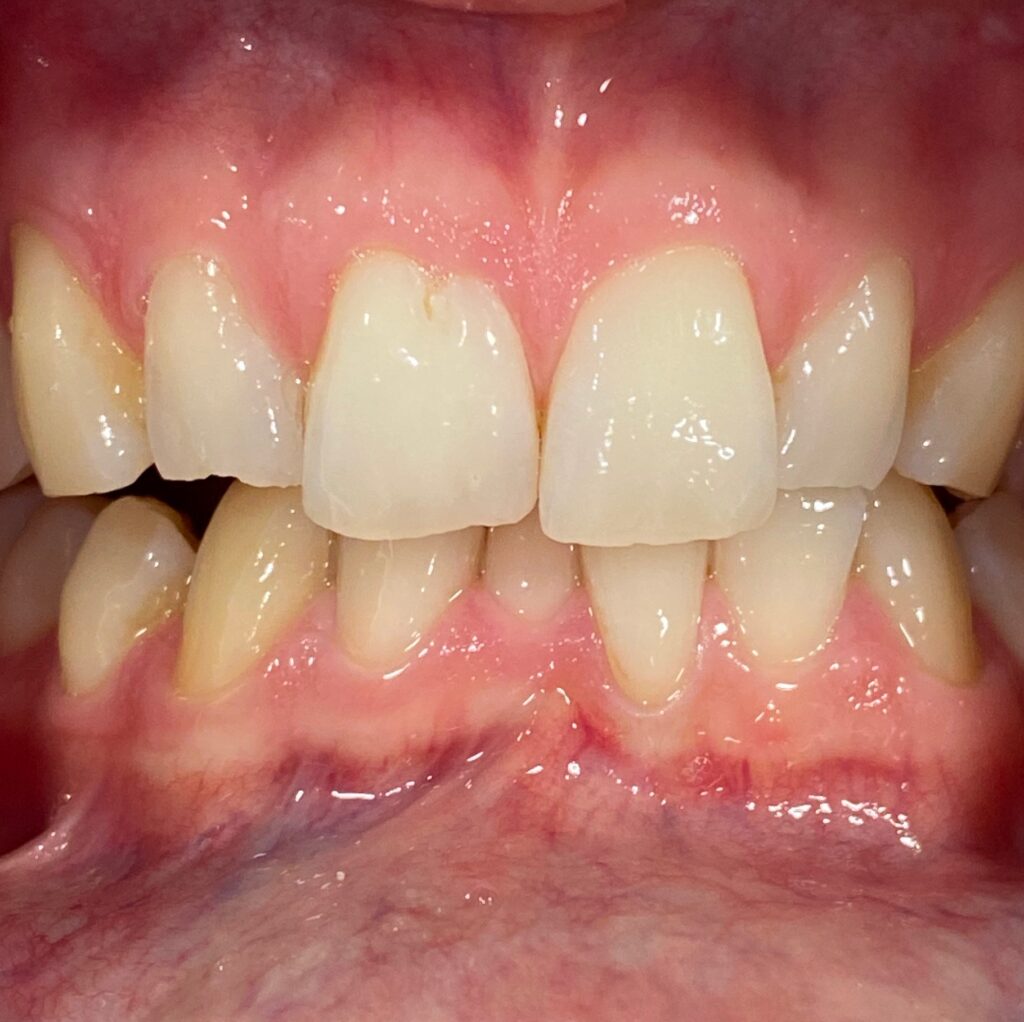 How can i whiten my teeth after smoking